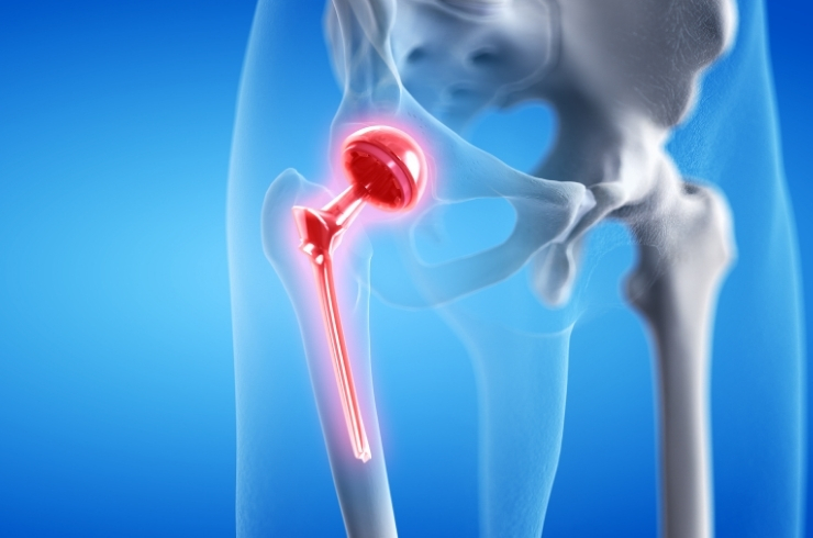 Hip replacement------34